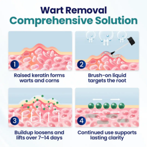 ROSOPL® WartLift Wart Removal Fluid 13 ROSOPL® WartLift Wart Removal Fluid